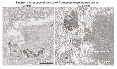 电子显微照片展示了92岁健康女性前额叶皮质中的典型小胶质细胞（左），以及91岁阿尔茨海默病女性患者的暗色小胶质细胞（右）。图片来源：美国纽约市立大学